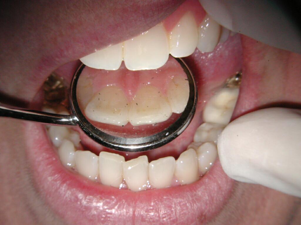 Upper incisor close to tooth .jpg